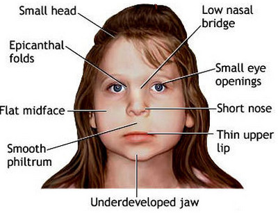 Can Fetal Alcohol Syndrome Cause Autism?